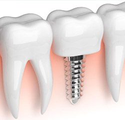  Dental Implant Technology